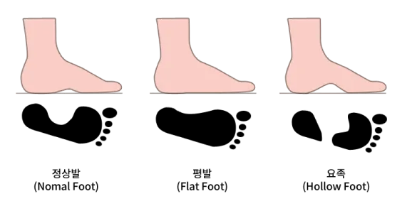 정상 발, 요족, 편평족 등 발 아치 형태별 족문 차이를 비교한 이미지