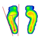 발 아치 유형에 따른 발바닥 압력 분포를 시각화한 족문분석 이미지