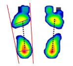 발 아치 유형에 따른 발바닥 압력 분포를 시각화한 족문분석 이미지